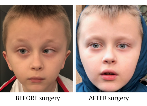 Strabismus Surgery