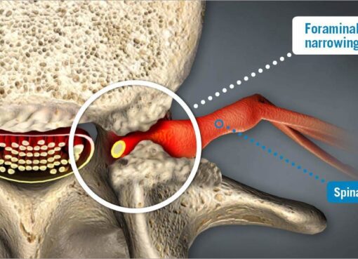 foraminal-narrowing-3d-render