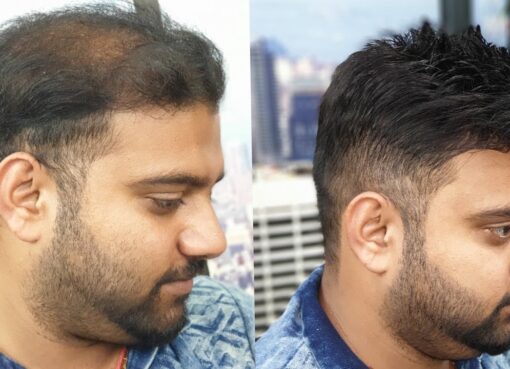 Best Hair Transplant in Islamabad