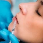 dermal fillers in Florida