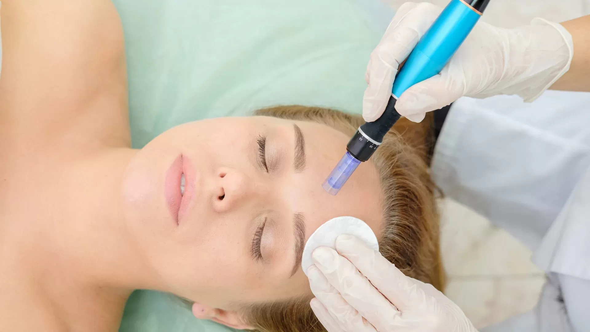 microneedling with prp