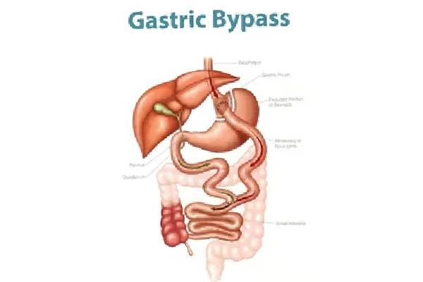 Finding the Best Gastric Bypass Surgeon: A Comprehensive Guide