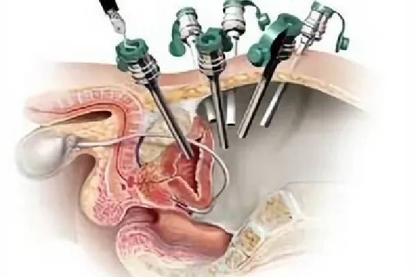 Prostate Removal Robotic Surgery: Revolutionizing Prostate Cancer Treatment