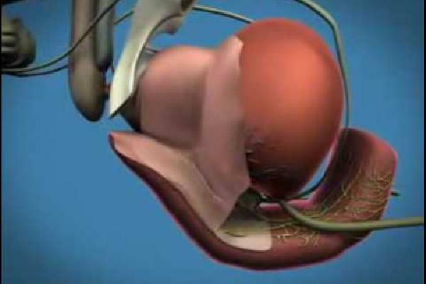 Prostate Removal Robotic Surgery: What You Need to Know