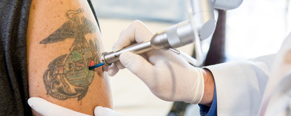 tattoo removal services in Brooklyn NY