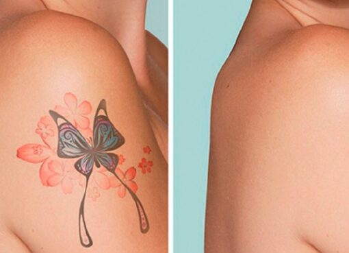 tattoo removal services in Ridgewood NY