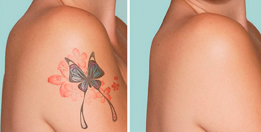 tattoo removal services in Ridgewood NY