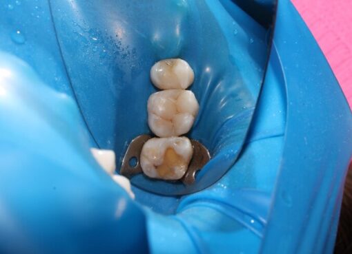 Porcelain Crowns St Petersburg FL