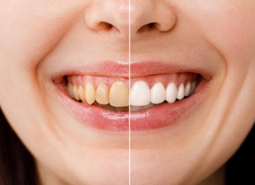 Teeth Whitening pittsburgh pa