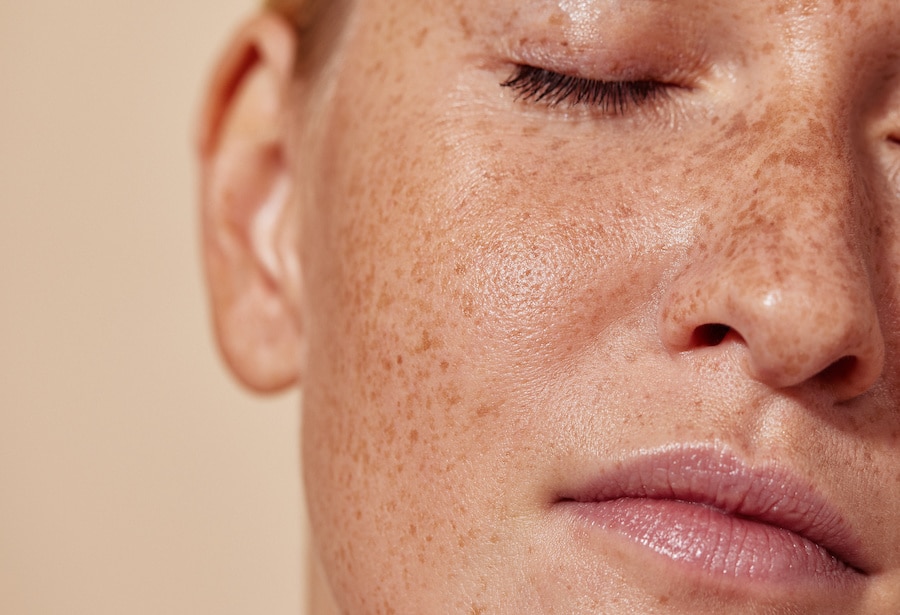 What are the Different Types of Lasers Used for Brown Spots Removal?