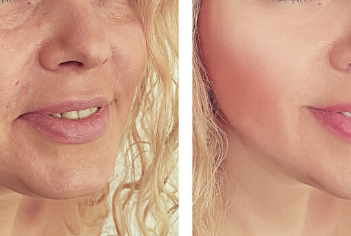7D Hifu facial treatment