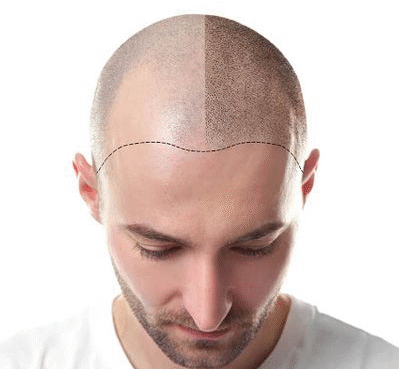 Hair Transplant in Riyadh