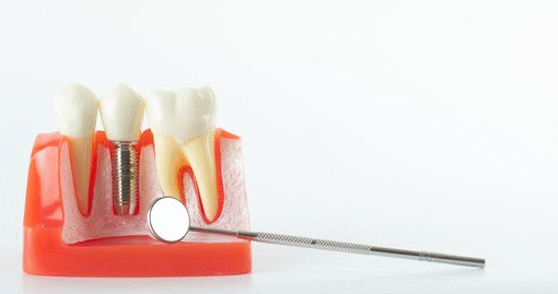 dental implants elberta al