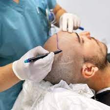 best hair transplant clinic in delhi