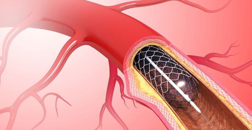Asia Pacific Aortic Stent Graft Market