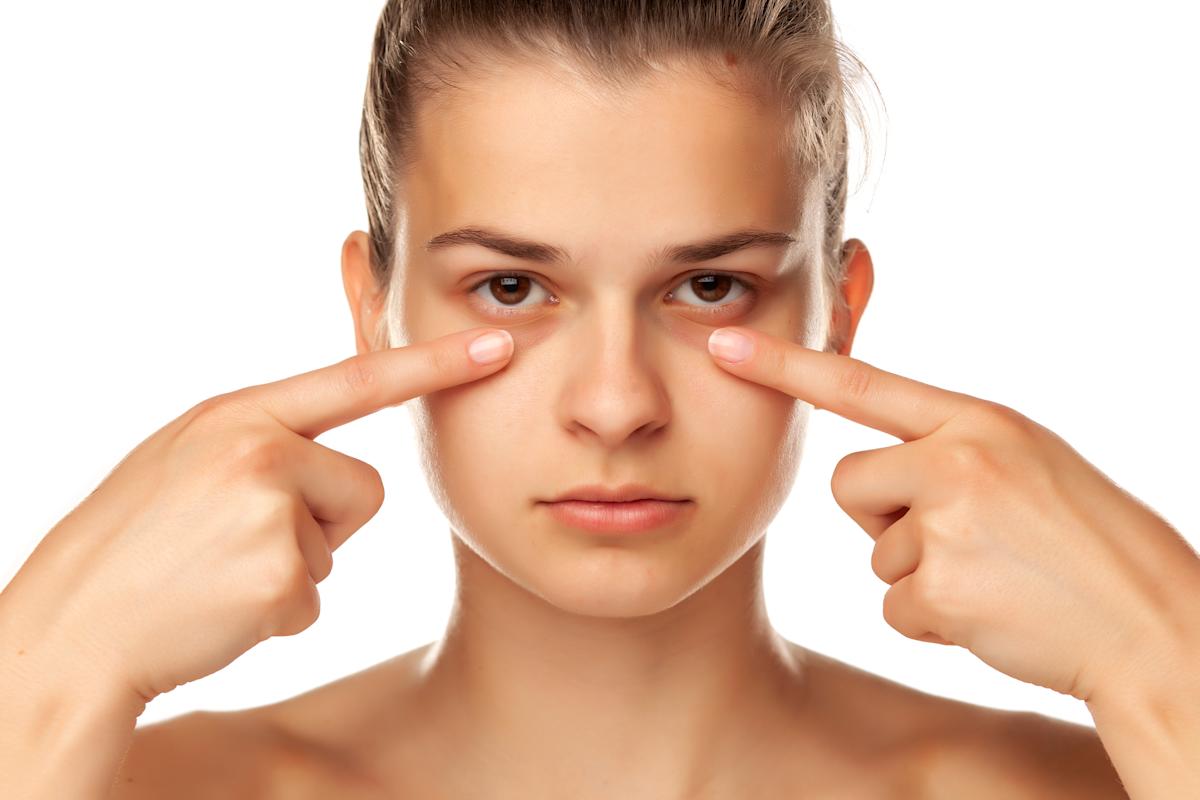 Dark Circles Treatment In Dubai