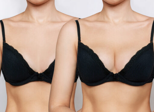 Saline vs. Silicone Implants Which Is Right for You