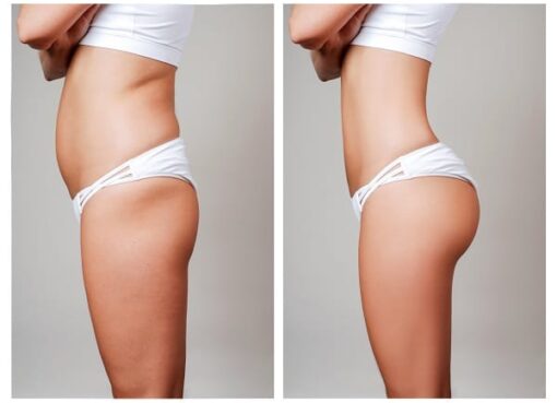 Female,Body,Before,And,After,Liposuction.,Plastic,Surgery,Concept.