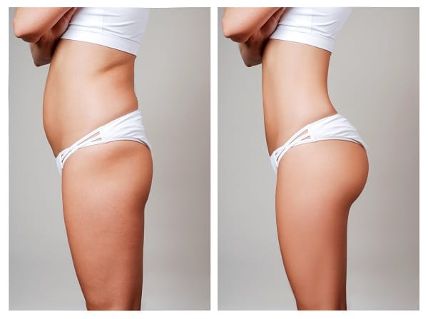 Female,Body,Before,And,After,Liposuction.,Plastic,Surgery,Concept.