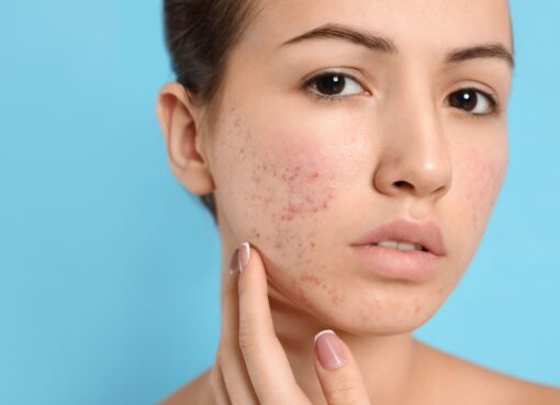 Acne Scar treatment in Islamabad