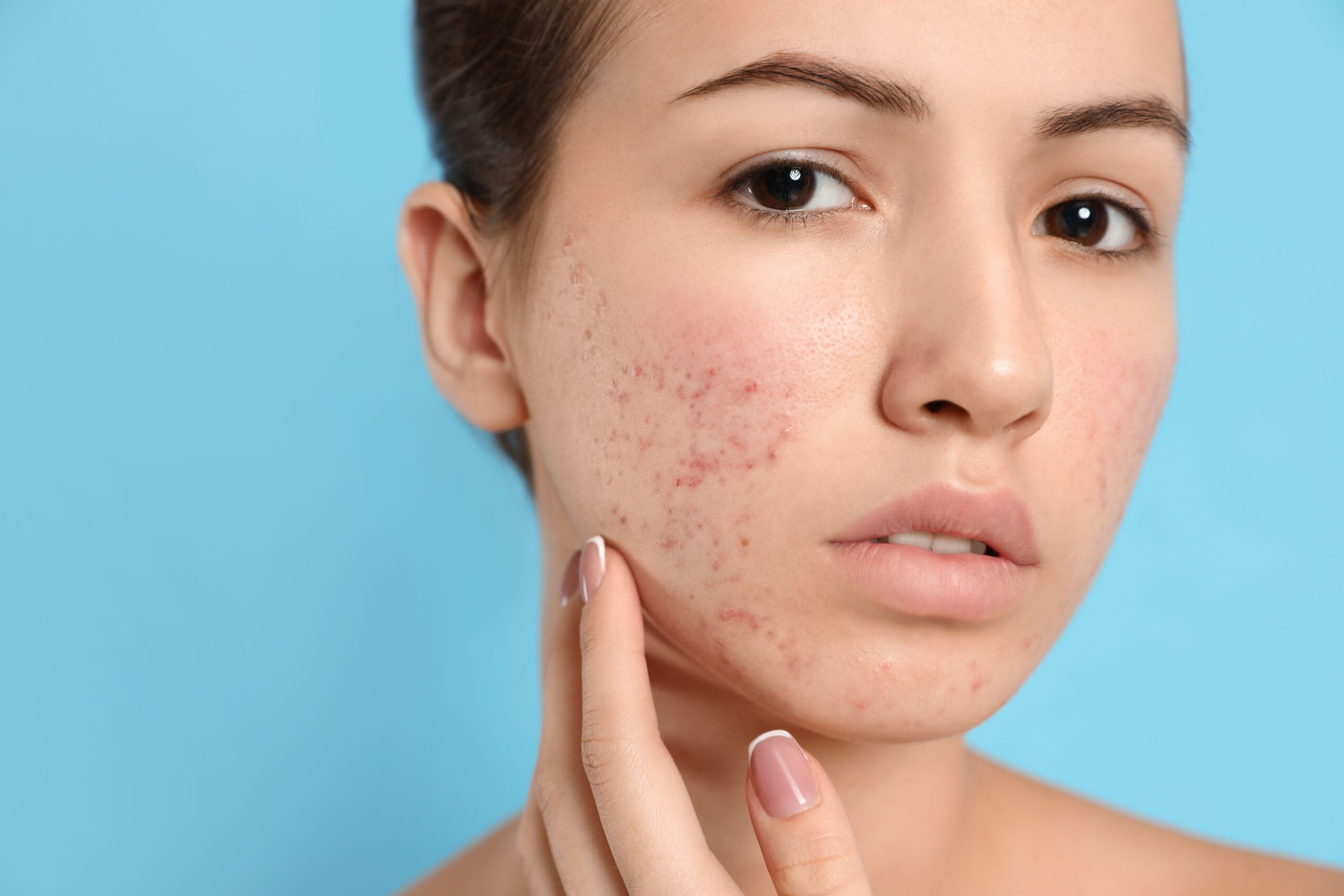 Acne Scar treatment in Islamabad