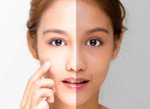 Skin whitening treatment in Islamabad