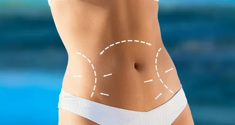 Liposuction in Riyadh