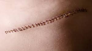 How Long Is Recovery After Surgical Scar Revision