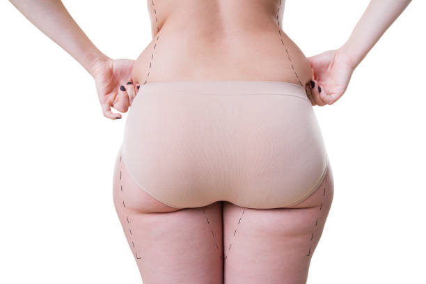 Comparing Liposuction Methods: Riyadh’s Most Effective Solutions