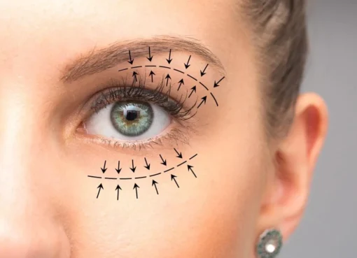 eyelid surgery in Islamabad