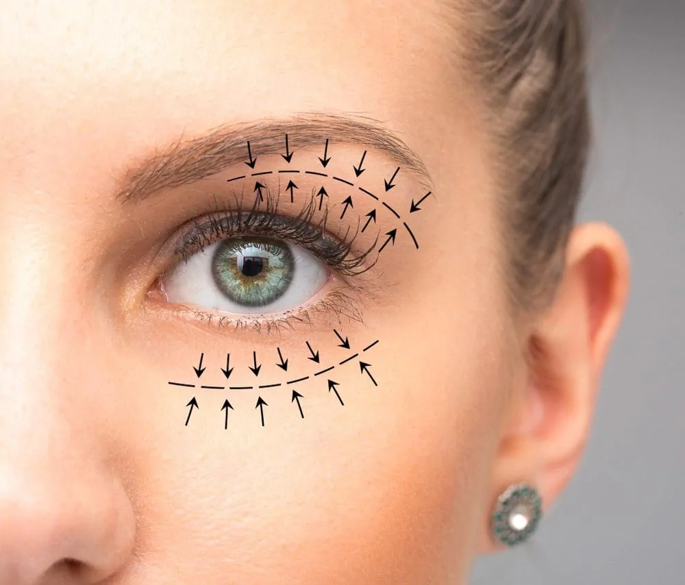 Refreshing Your Look: Understanding Eyelid Surgery in Islamabad