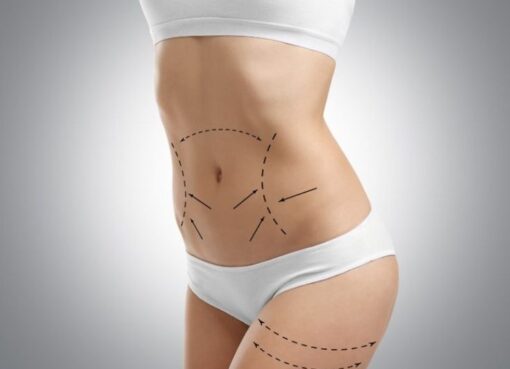 How Liposuction and Tummy Tuck Improve Contours