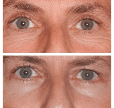 Eye Bag Removal