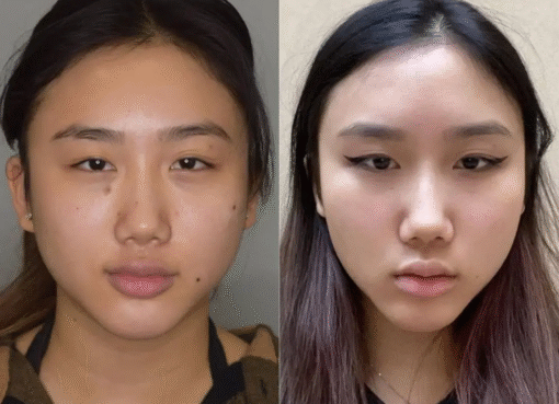Buccal Fat Removal