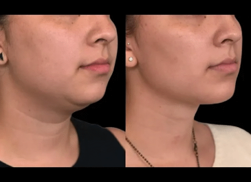 Double chin removal