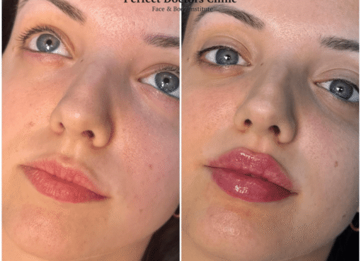 Juvederm