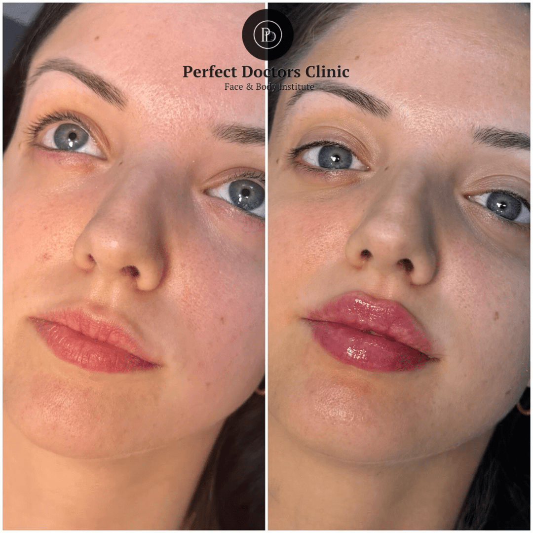 How to Achieve Natural-Looking Results with Juvederm: Advice from the Best Plastic Surgeon in Dubai