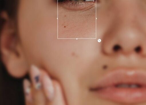Eyelid Surgery in Riyadh