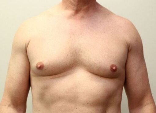 Riyadh Gynecomastia Surgery: Cost and Recovery Guide
