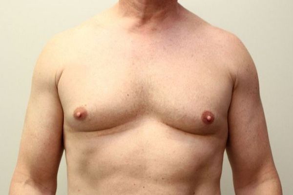 Riyadh Gynecomastia Surgery: Cost and Recovery Guide