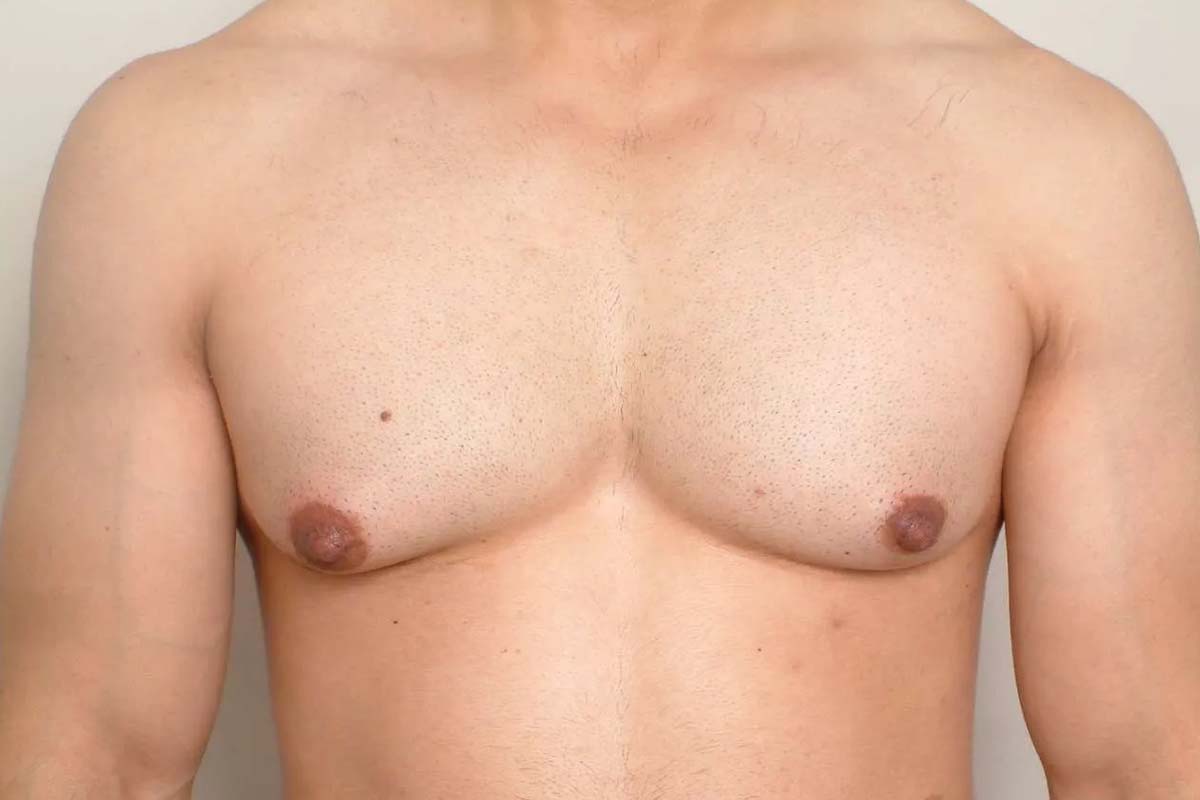 Riyadh Guide to Gynecomastia Surgery Options