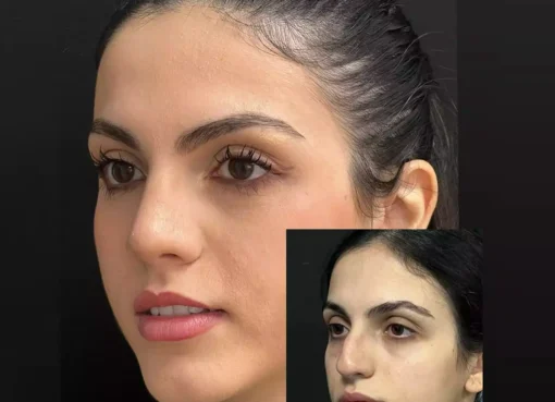 Rhinoplasty in Dubai