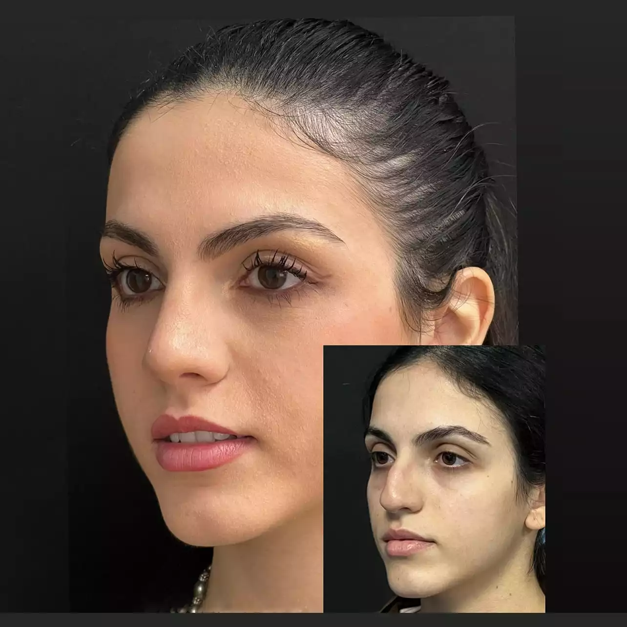 Can the Best Rhinoplasty Surgeon in Dubai Perform Revision Cases?