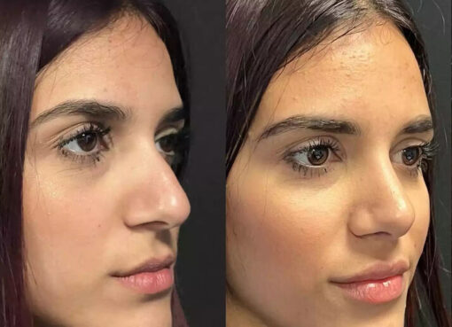 Septoplasty in Dubai