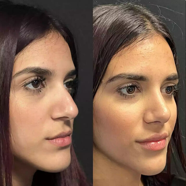 How Affordable Is the Best Septoplasty Surgeon in Dubai?