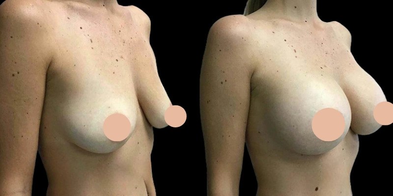 Best Breast Augmentation Surgeon in Dubai Answers the Most Asked Patient Questions