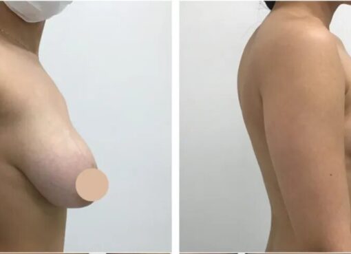 breast lift in dubai