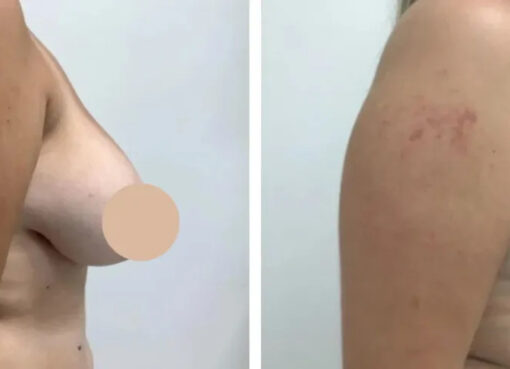 breast reduction in dubai