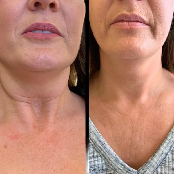 Anchor Your Youth with Profhilo at the Best Aesthetic Clinic in dubai