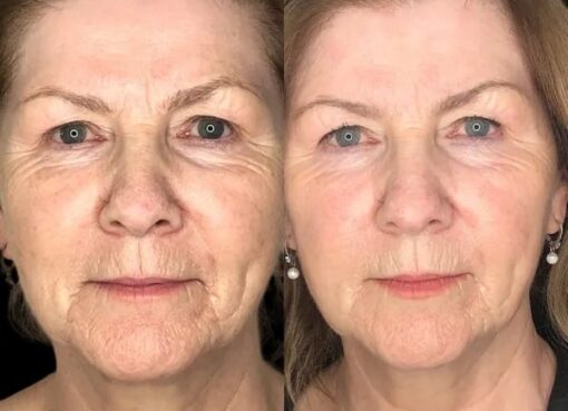 Profhilo treatment in dubai